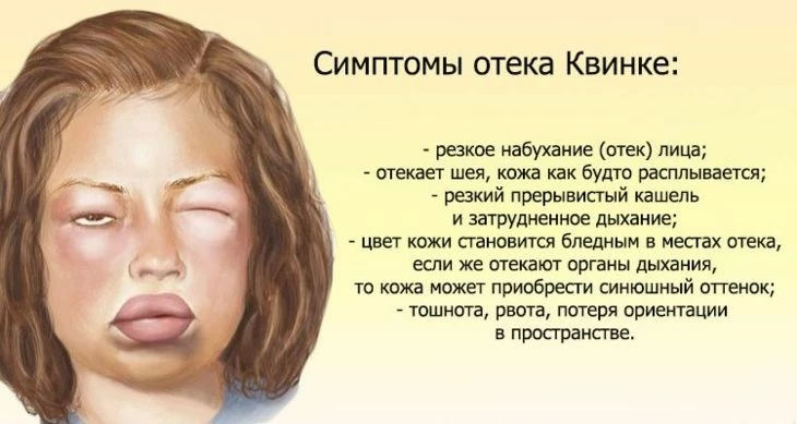 Лайфхак, как бесплатно закосплеить Олега Монгола. А если серьезно, при таких симптомах обязательно нужно вызывать скорую!