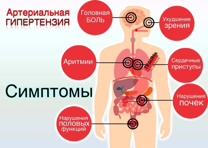 Симптоматика гипертонии в виде инфографики очень хорошо привлекает внимание ЦА