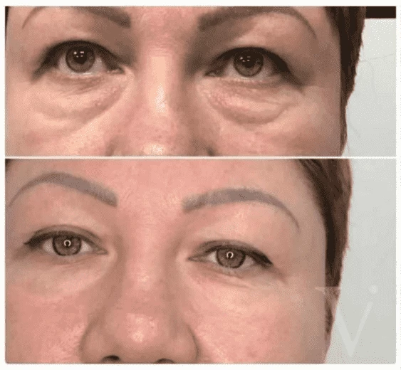Before/After image
